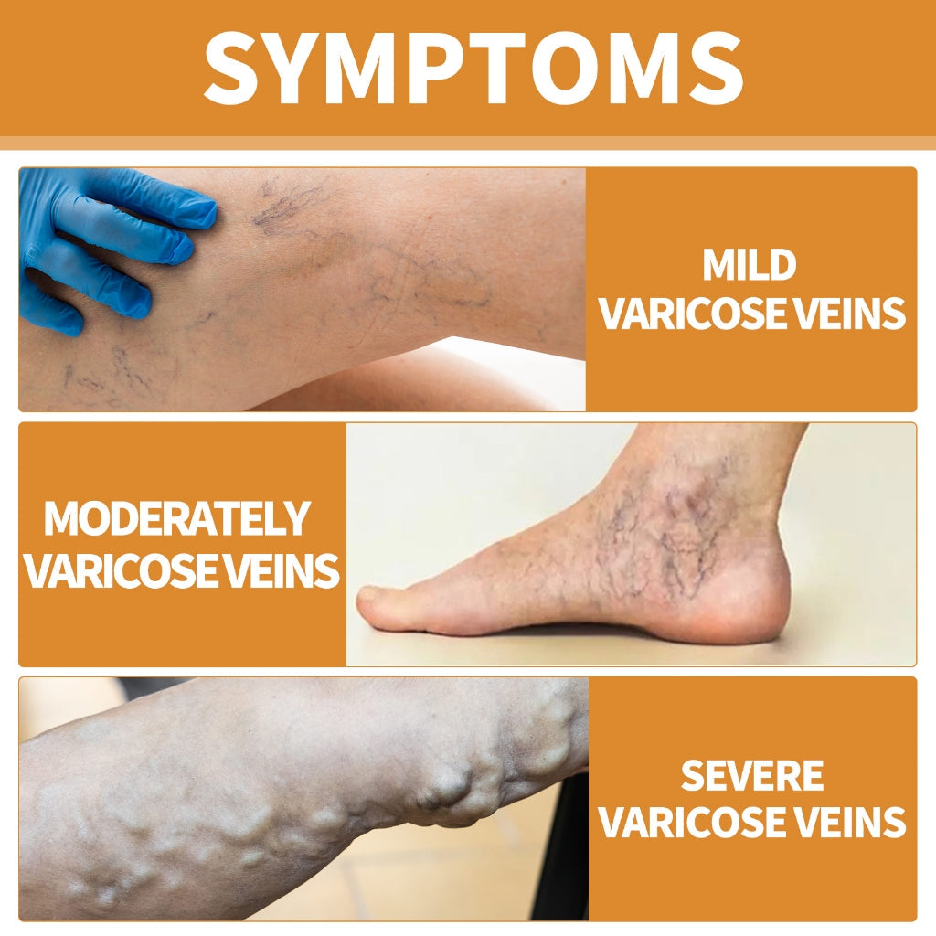 Turmeric Varicose Vein Relief Spray