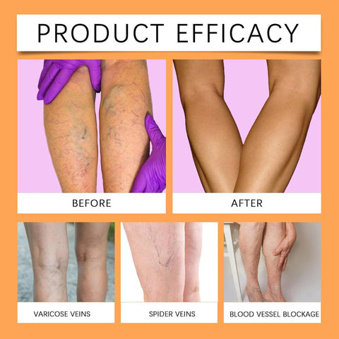 Turmeric Varicose Vein Relief Spray